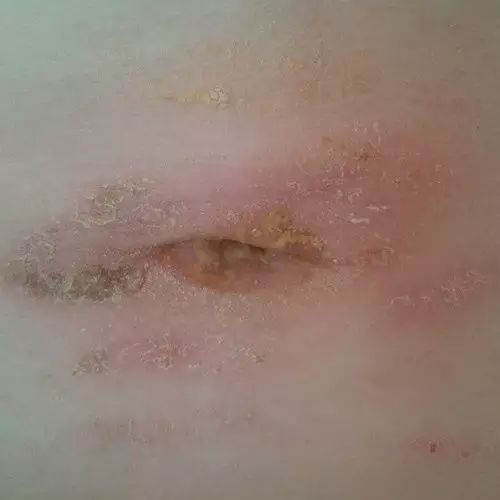 原始点调理肚脐疼痛案例 原始点调理肚脐疼痛案例