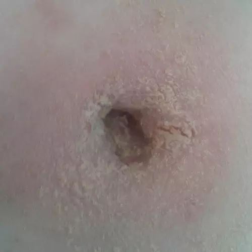 原始点调理肚脐疼痛案例 原始点调理肚脐疼痛案例