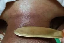 咳嗽，肩周炎案例-原始點全球同學網