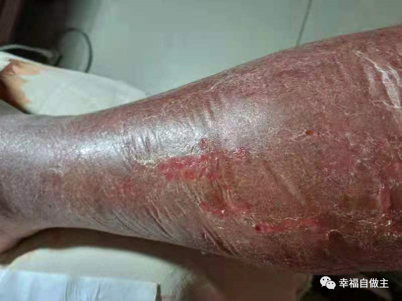 过敏性皮肤炎案例