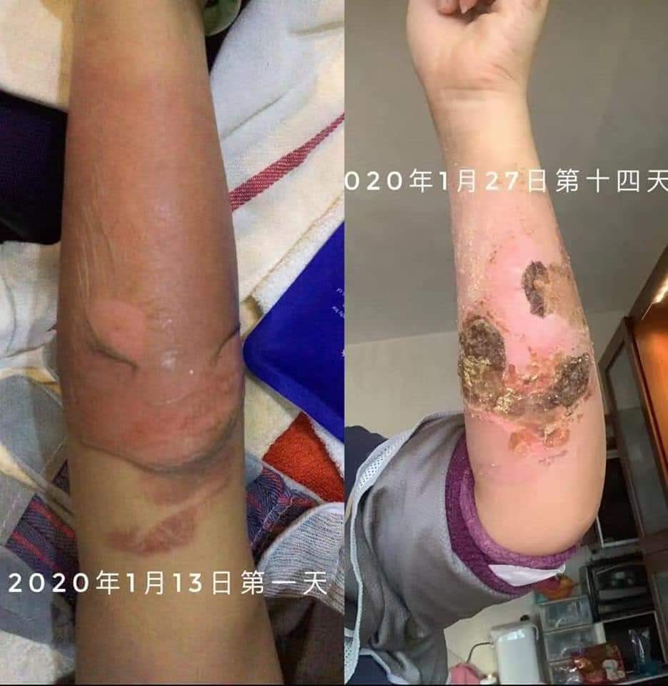 香港 公益点分享高压锅烫伤处理修复过程-原始点全球同学网