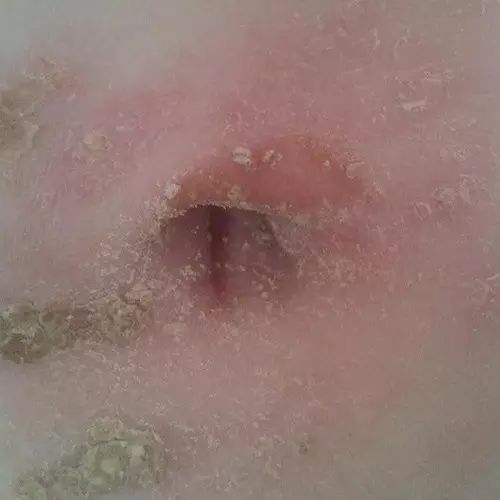 原始点调理肚脐疼痛案例 原始点调理肚脐疼痛案例