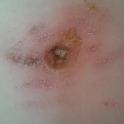 原始点调理肚脐疼痛案例 原始点调理肚脐疼痛案例
