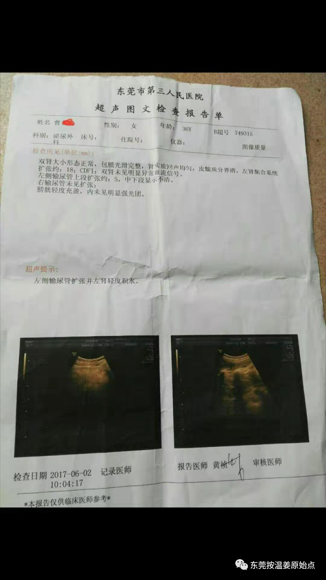 肾结石,输尿管扩张,肾轻度积水 肾结石,输尿管扩张,肾轻度积水