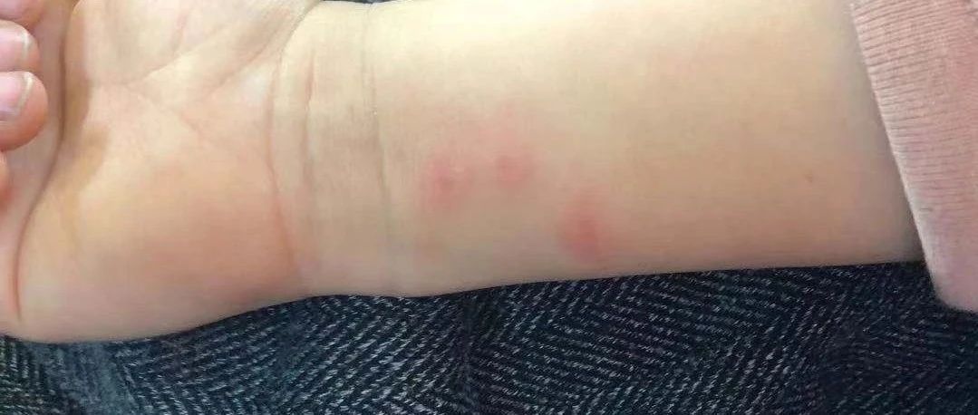 微问答229期:小孩长了一身的红疙瘩原始点如何调理?-原始点全球同学网