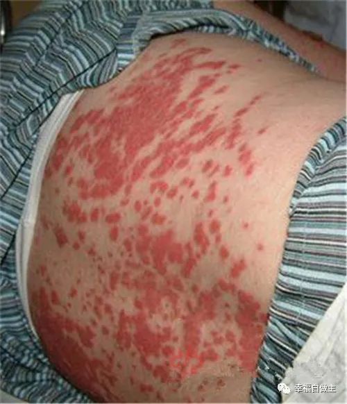 红斑狼疮患者避免复发案例 红斑狼疮患者避免复发案例