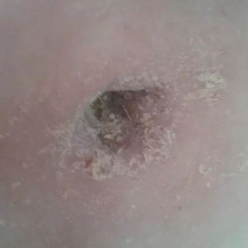 原始点调理肚脐疼痛案例 原始点调理肚脐疼痛案例
