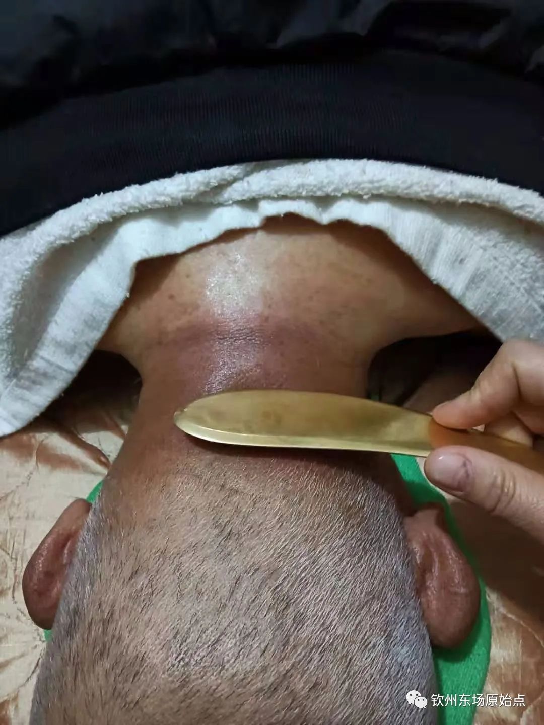 咳嗽,肩周炎案例 咳嗽,肩周炎案例