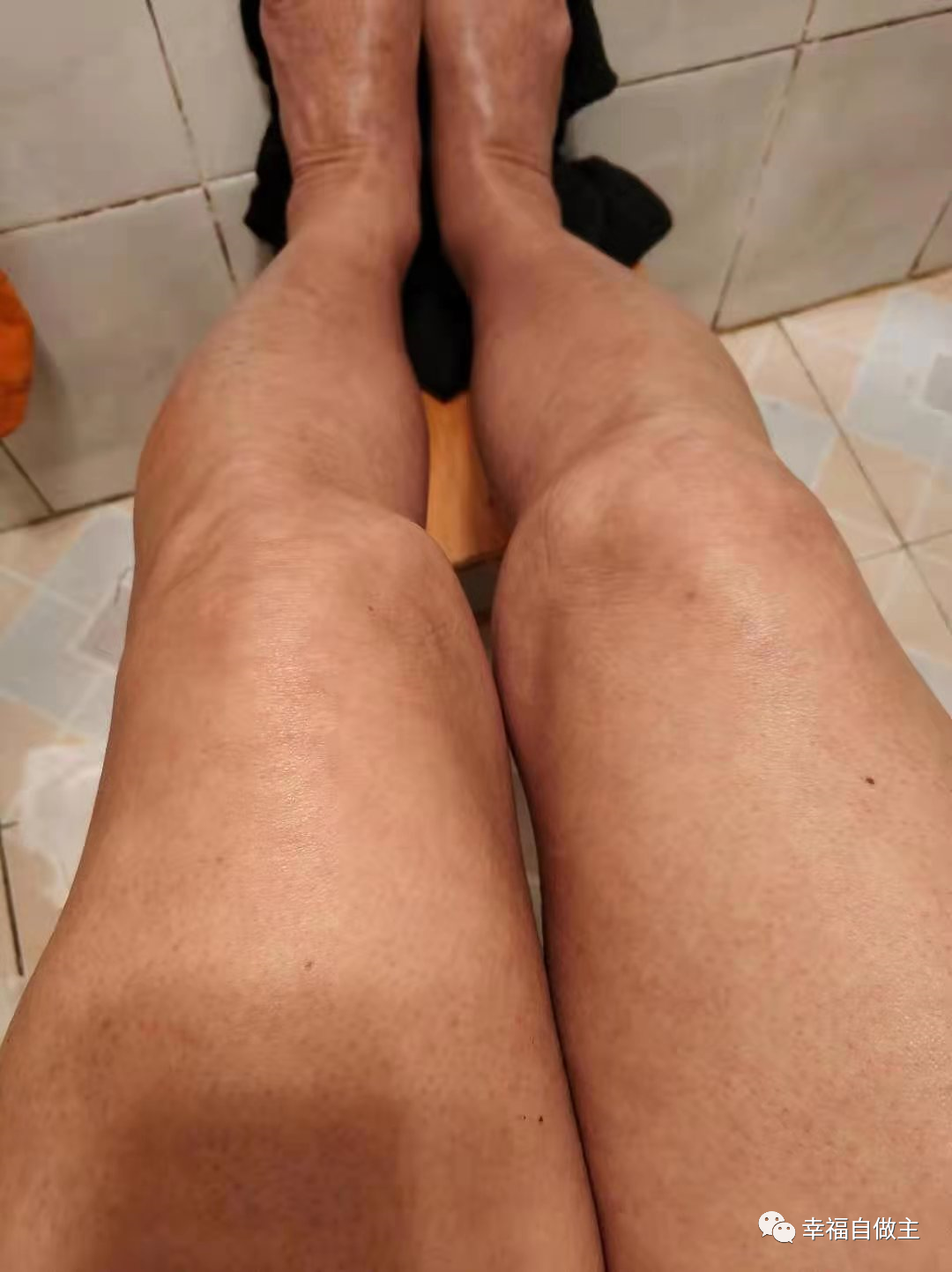 过敏性皮肤炎案例