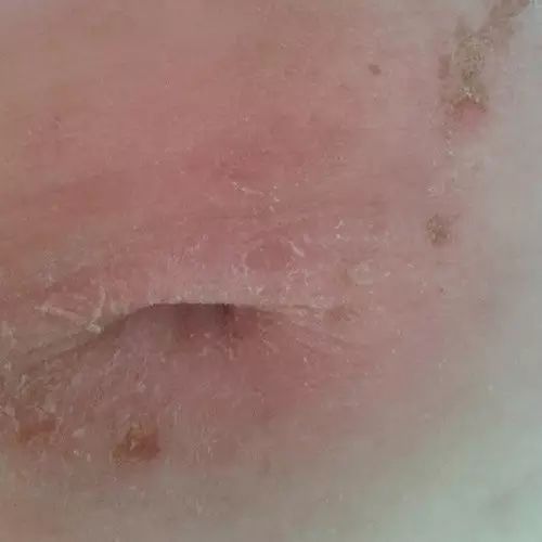 原始点调理肚脐疼痛案例 原始点调理肚脐疼痛案例