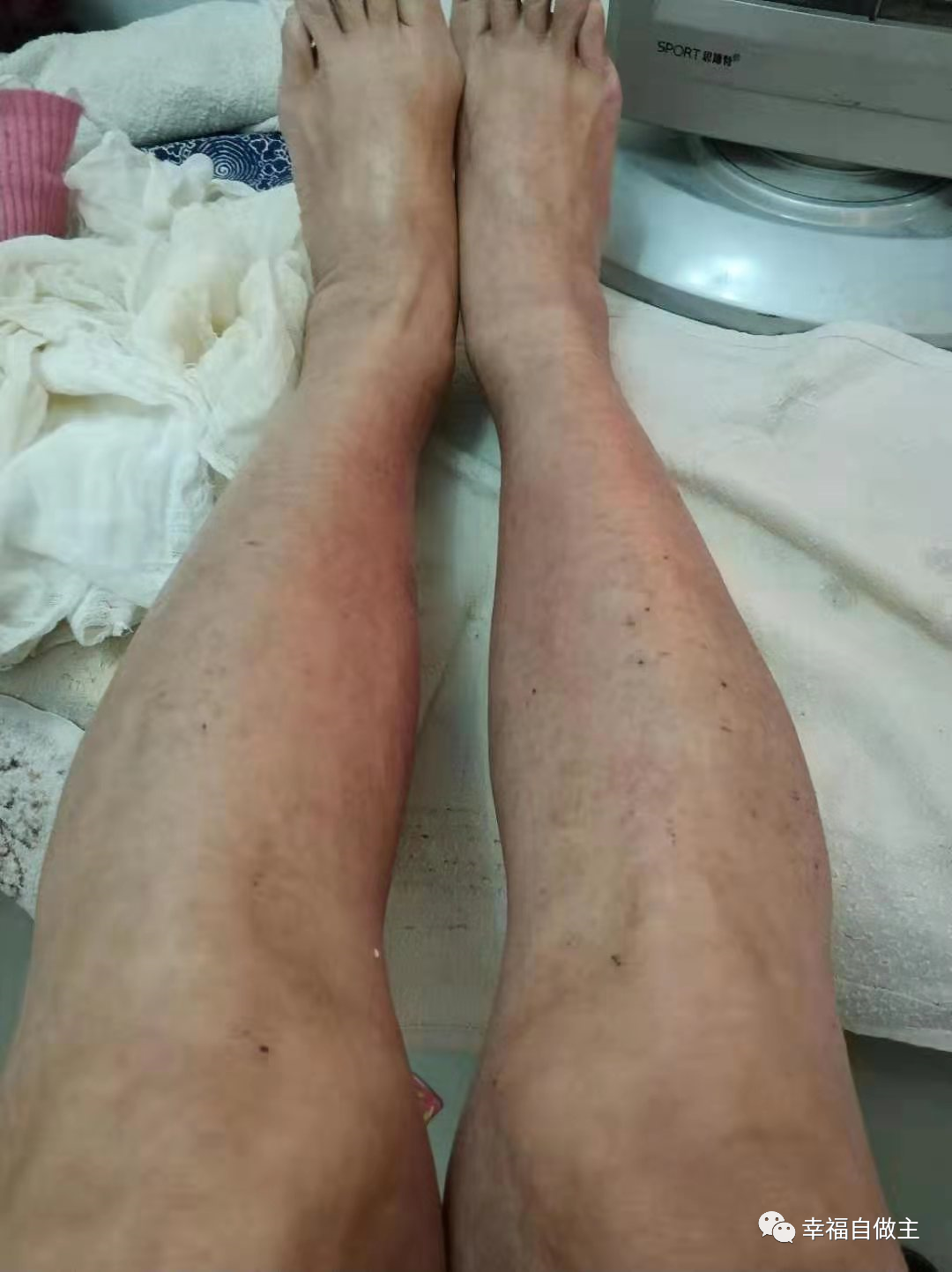 过敏性皮肤炎案例