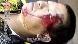 多处严重外伤案例(简体版)-原始点全球同学网