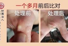 手掌软骨增生案例-原始点全球同学网