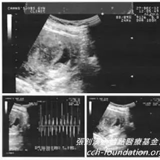 胎死腹中案例（台湾）（简体版）-原始点全球同学网