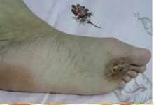 鸡眼用原始点处理9天痊愈案例(简体版)-原始点全球同学网