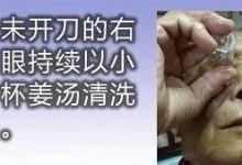 白内障姜汤洗眼案例-原始点全球同学网