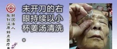 白内障姜汤洗眼案例-原始点全球同学网