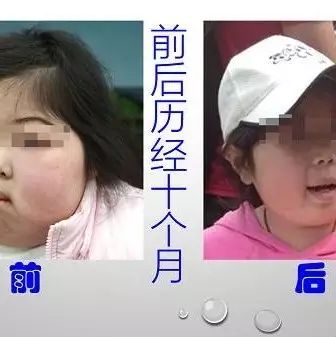 肾病症候群案例（简体版）-原始点全球同学网