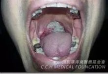 邓先生扁桃腺癌案例-原始点全球同学网