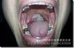 邓先生扁桃腺癌案例-原始点全球同学网