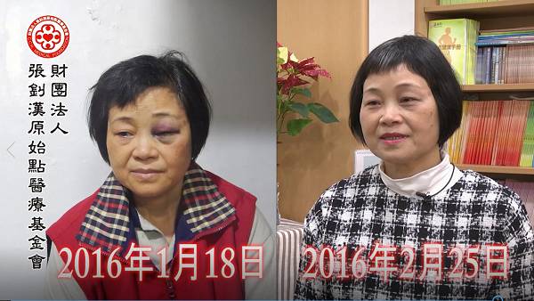 车祸头部外伤出血案例(简体版) 车祸头部外伤出血案例(简体版)