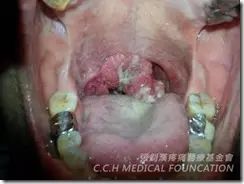扁桃腺癌案例