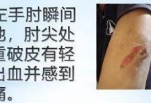 手肘受伤案例-原始点全球同学网