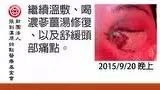 眼部撞伤案例-原始点全球同学网