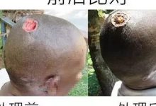 头部溃烂案例（简体版）-原始点全球同学网