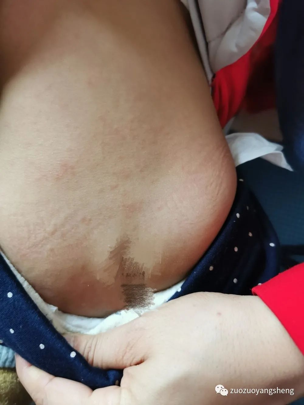 案例分享：原始点调理反复高烧和婴幼儿急疹案例