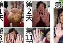 手部水泡案例-原始点全球同学网