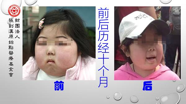 肾病症候群案例(简体版) 肾病症候群案例(简体版)