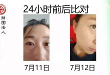 结膜炎案例-原始点全球同学网