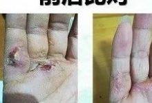 手部外伤案例-原始点全球同学网