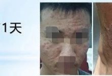 张先生,18岁虫咬致全身过敏案例-2019-6-原始点全球同学网