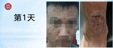 张先生，18岁虫咬致全身过敏案例-2019-6-原始点全球同学网