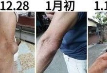 手肘肿案例（更新）-原始点全球同学网