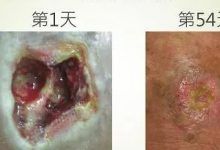 脚部伤口案例(简体版)-原始点全球同学网