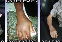 手骨折案例(老人)(简体版)-原始点全球同学网