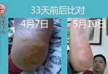 脚后跟鸡眼案例-原始点全球同学网