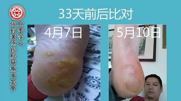 脚后跟鸡眼案例-原始点全球同学网