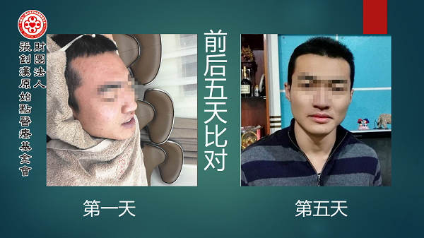 发烧四十度案例(简体版) 发烧四十度案例(简体版)