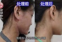 异位性皮肤炎案例(王小姐)(简体版)-2017.8最新案例-原始点全球同学网