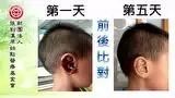 耳伤案例(小孩)-原始点全球同学网