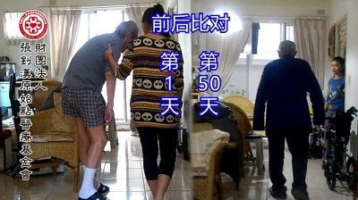 温敷过度烫伤案例-原始点全球同学网