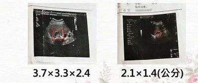 肾上腺瘤免除手术案例-原始点全球同学网