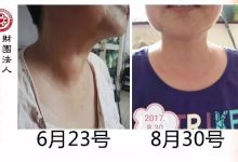 甲状腺结节案例-原始点全球同学网