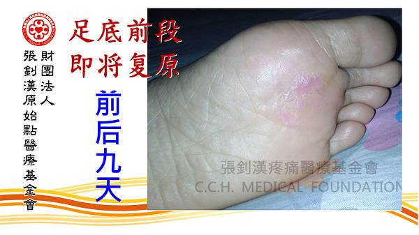 鸡眼用原始点处理9天痊愈案例（简体版）