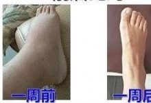 脚肿案例-原始点全球同学网