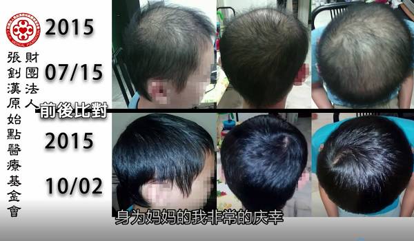 少年脱发案例(马国)(简体版) 少年脱发案例(马国)(简体版)